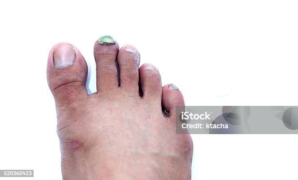Broken Toe Nail Stock Photo - Download Image Now - Problems, Toenail, Animal Body - iStock Broken Toe Nail Stock Photo - Download Image Now - Problems, Toenail, Animal Body - iStock