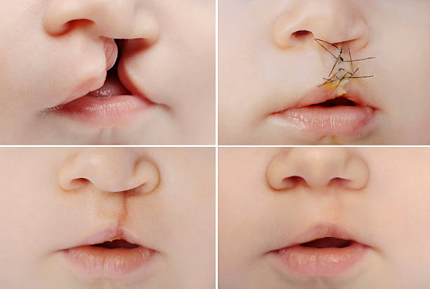 Baby with cleft before and after surgery Closeup on lips of baby with lip and palate cleft before and after surgery. cleft lip stock pictures, royalty-free photos & images