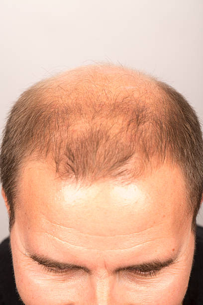 contrôles perte de cheveux homme - hair loss human age side view black and white photos et images de collection
