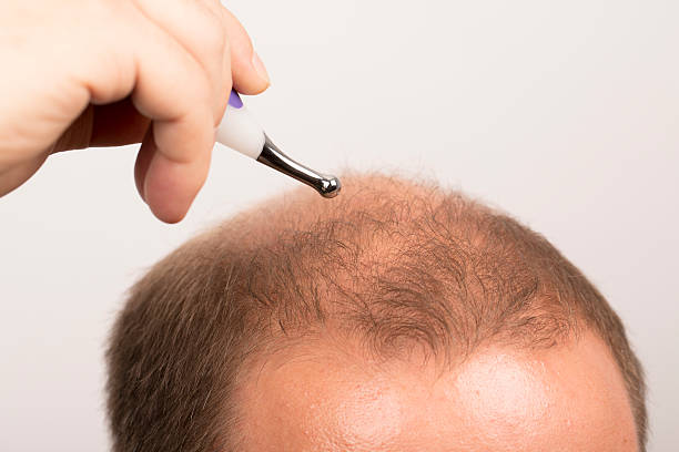 istock man controls hair loss 520649508