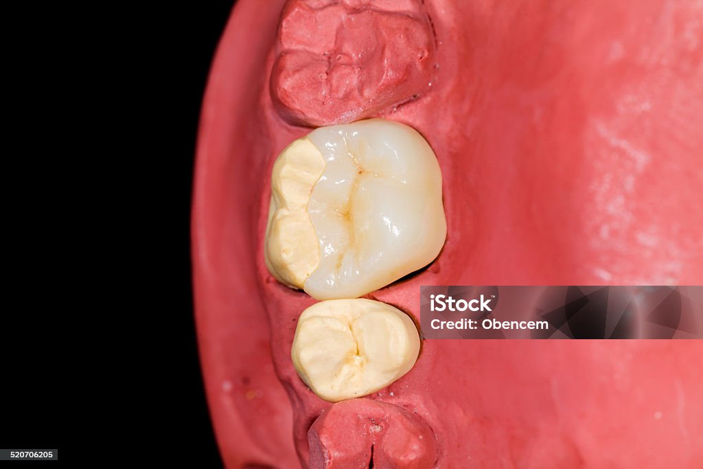 Ceramic molar onlay Ceramic molar onlay on red gypsum model on isolated background Bonding Stock Photo