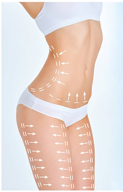 istock The cellulite removal plan. White markings on young woman body 520738078