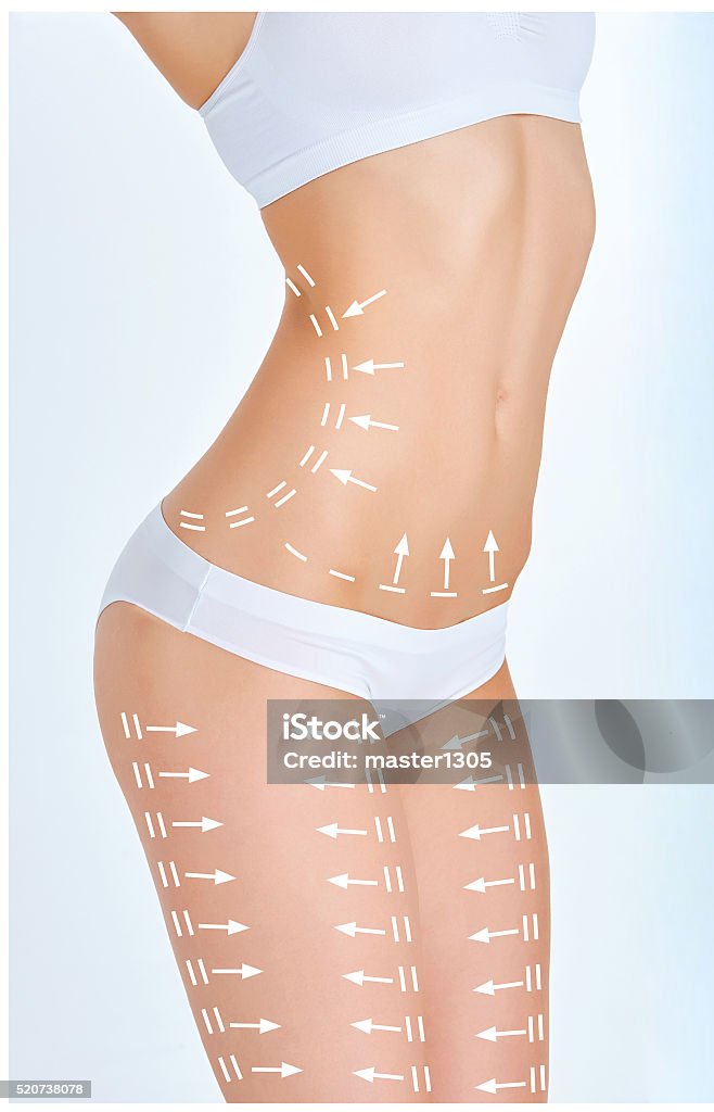 The cellulite removal plan. White markings on young woman body The cellulite removal plan. White markings on young woman body preparing for plastic surgery. Concept of slimming, liposuction, strand lifting The Human Body Stock Photo