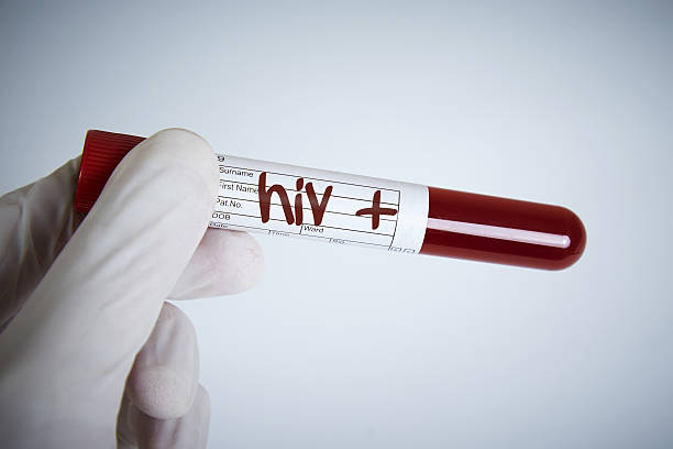 prueba de detección de vih, es vih positivo. - aids fotografías e imágenes de stock