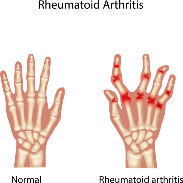 kreskówka ilustracja reumatoidalnym arthi - metacarpal stock illustrations