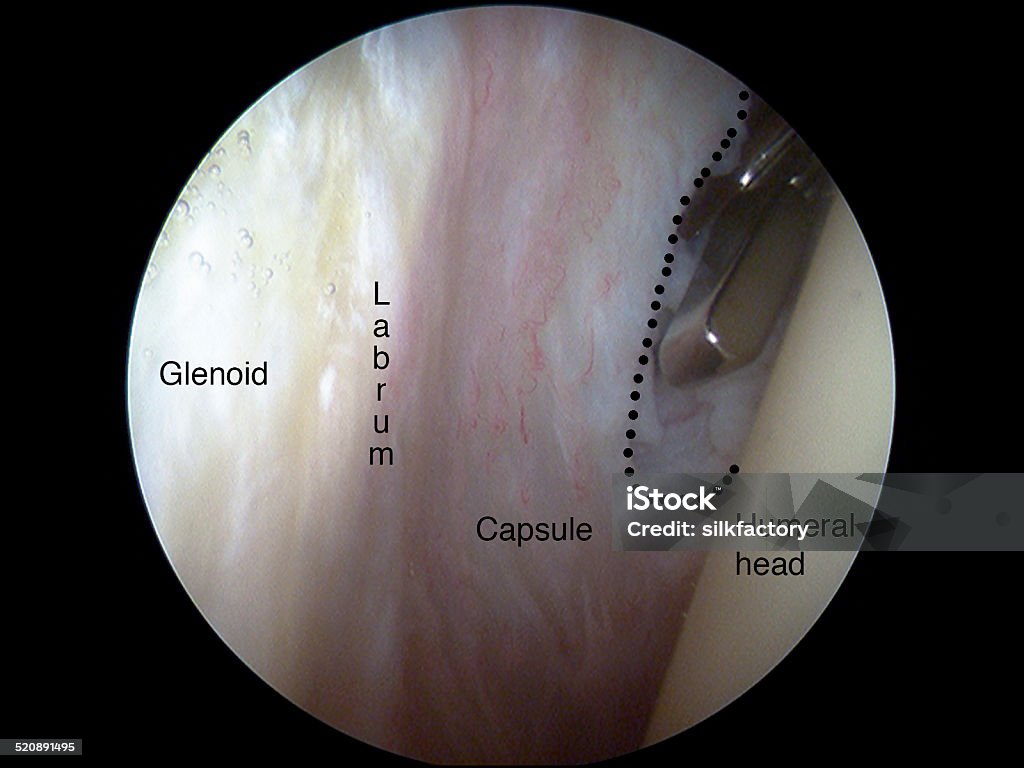 Arthroscopic capsulotomy in frozen shoulder of the shoulder Arthroscopic view (from posterior portal) of a right shoulder suffering from adhesive capsulitis (or frozen shoulder). An anterior capsulotomy - marked with dotted line - is being performed by a meniscal (upbiter) punch. Arthroscopic Surgery Stock Photo