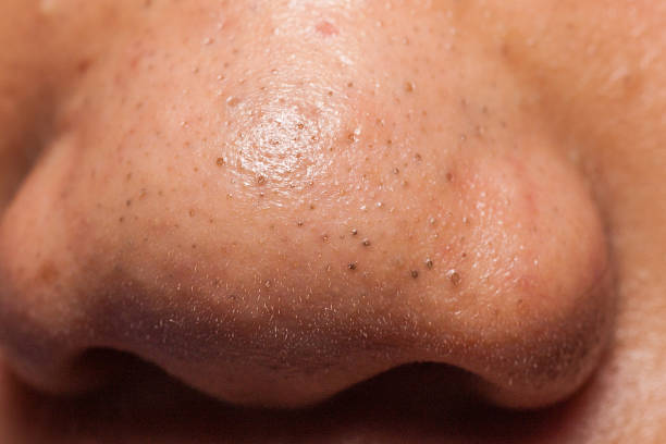 istock Blackheads on the nose 521200217