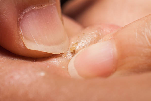 istock Extracting multiple pimple blackheads from nose 521200443