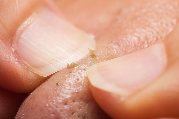 Extracting pimple blackheads from the nose