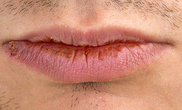 istock Manifestation of herpes 521261085