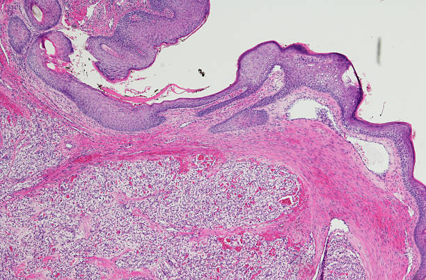 claro célula carcinoma de células renales (ccrcc - kidney cancer fotografías e imágenes de stock