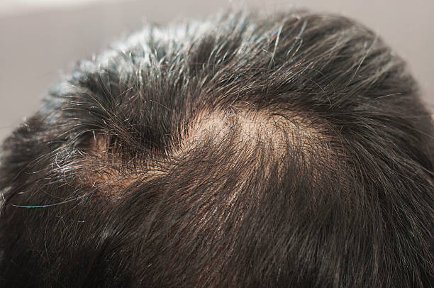 istock Scalp and Hair loss 521310972