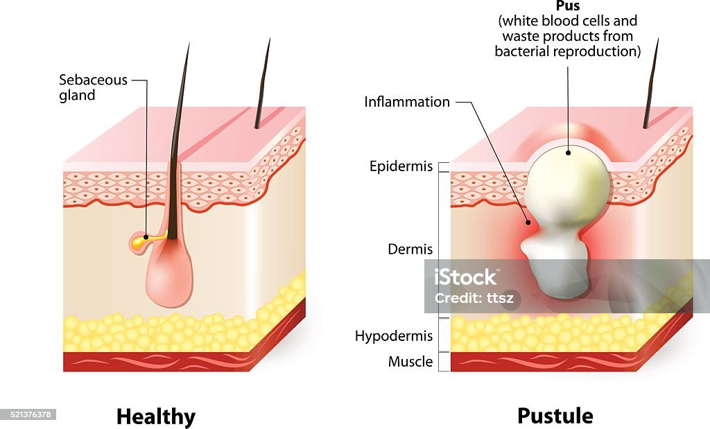 Sana de la piel y Pústulas - arte vectorial de Glándula sebácea libre de derechos