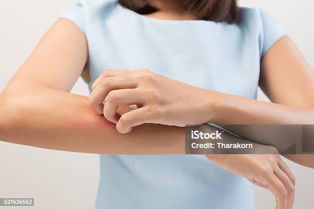 Itching Stock Photo - Download Image Now - Scratching, Eczema, Skin Condition
