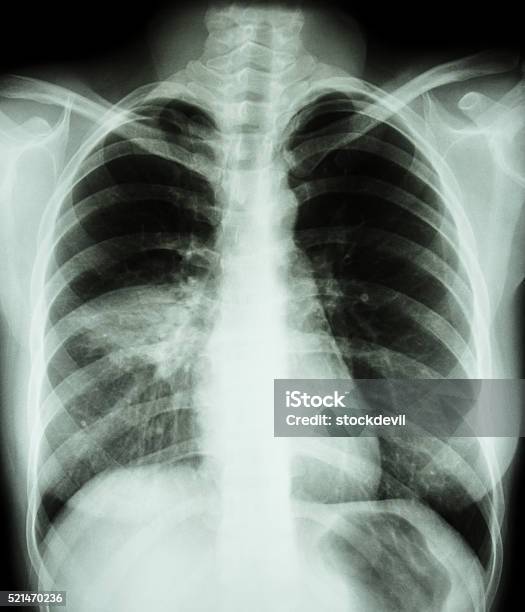 Foto de Pneumonia e mais fotos de stock de Arraia - Peixe - Arraia - Peixe, Pneumonia, Imagem de raios X