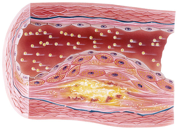 Atherosclerosis Vascular atherosclerosis showing a cutaway view of accumulated plaque in an afflicted blood vessel. This condition is entirely avoidable and reversable with a plant based diet. endothelial stock pictures, royalty-free photos & images
