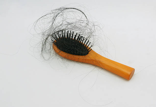 istock Hair loss and hair-comb 521700295