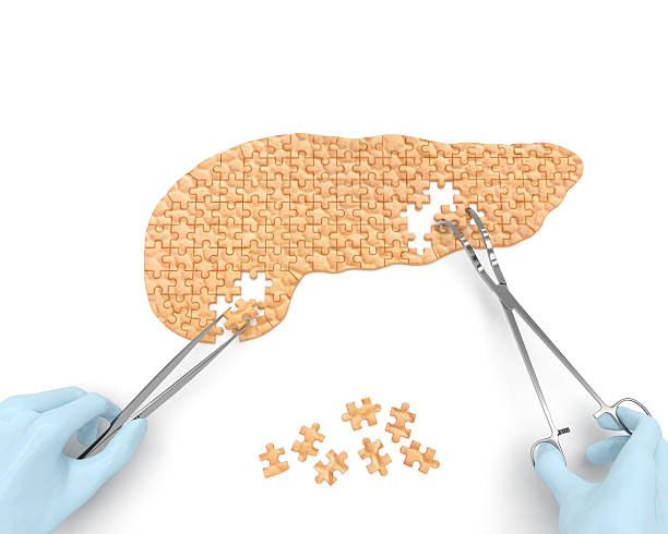 la operación de cirugía pancreática (rompecabezas de medicina concepto) - páncreas fotos fotografías e imágenes de stock