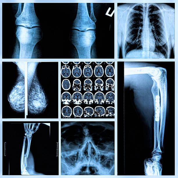 istock Radiography of Human Bones 521877203