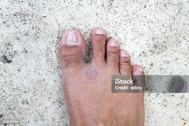 Foot Fungus Stock Photo - Download Image Now - Adult, Barefoot, Close-up