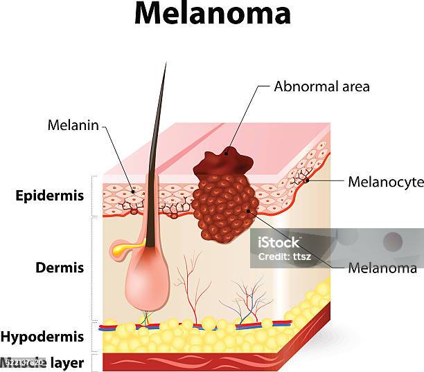 Ilustración de Cáncer De Piel Melanoma y más Vectores Libres de Derechos de Lunar - Lunar, Melanoma, Anatomía