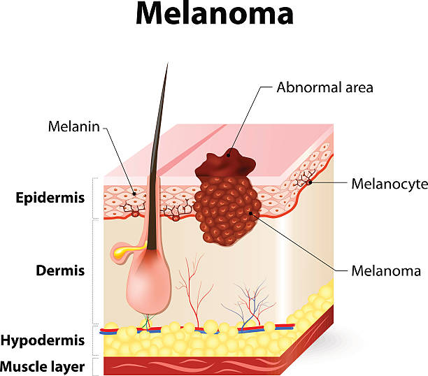 illustrazioni stock, clip art, cartoni animati e icone di tendenza di cancro alla pelle. melanoma di - neo