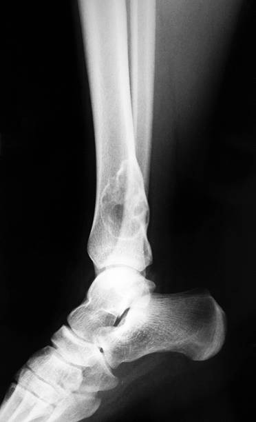 istock Benign bone tumor at the distal of tibia X-ray 1/2 522241335