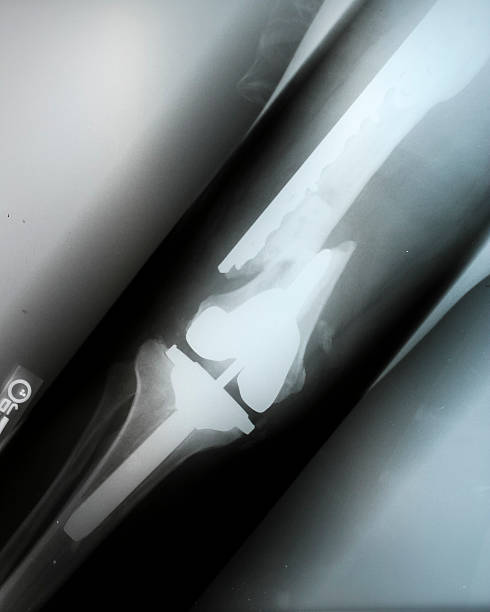 złamanie kości udowej - x ray human knee orthopedic equipment human bone zdjęcia i obrazy z banku zdjęć