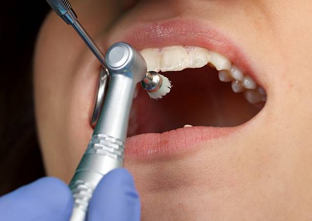 Professional dental brushing stock photo