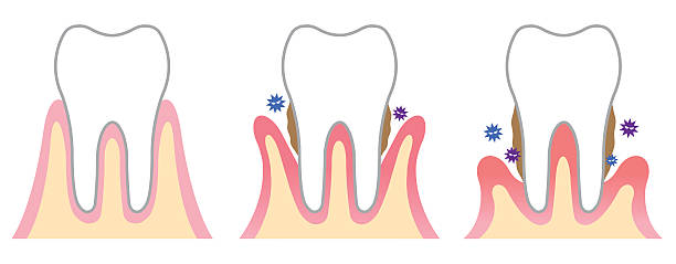 歯周病 イラスト素材 | 歯茎, 虫歯, 歯ブラシ - iStock