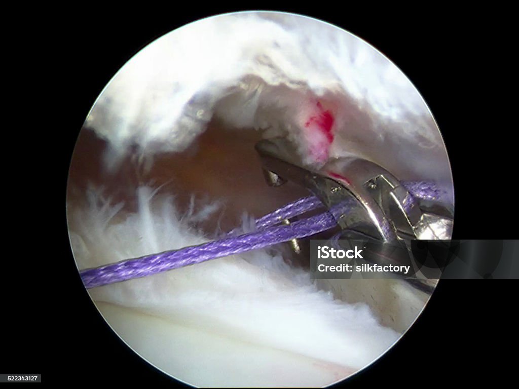 Arthroscopic view of repair of U-shaped supraspinatus tear Arthroscopic view (from a lateral portal) of the subacromial space of the right shoulder with a U-shaped rupture of the supraspinatus tendon being repaired. A needle with attached blue braided suture has penetrated both parts of the tear. Both ends of the suture are being retrieved with a suture grasper (or suture manipulator) - a necessary step before they can be tied in a knot. Anatomy Stock Photo