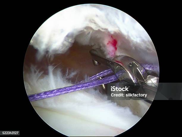 Arthroscopic View Of Repair Of Ushaped Supraspinatus Tear Stock Photo - Download Image Now