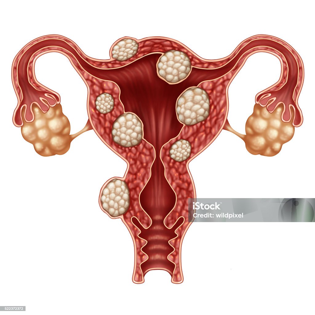 Uterine Fibroid Uterine fibroid medical concept as a human female reproduction uterus disease symbol for fertility problems and reproductive system health. Uterine Fibroid Stock Photo