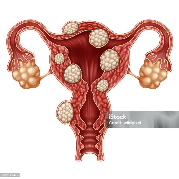 Uterine Fibroid Stock Photo - Download Image Now - Uterine Fibroid, Uterus, Endometriosis
