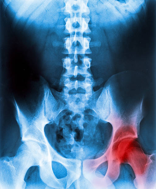 istock X-ray Of A Human Pelvis, Hips And Spine 522520533