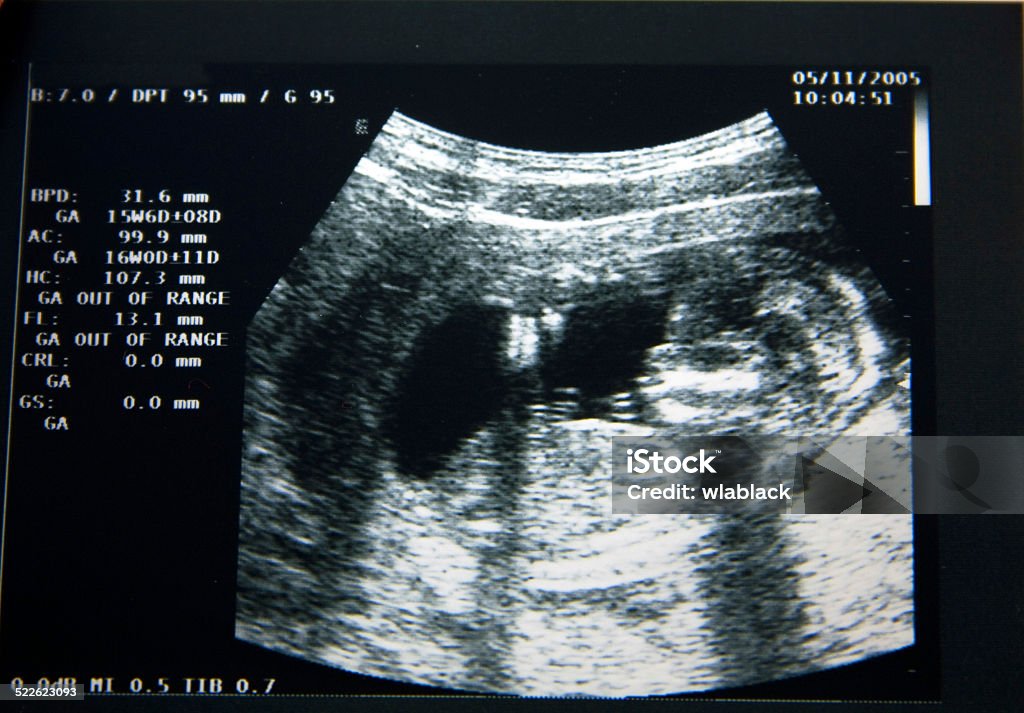 New life, ecografy Echo of the baby in  womb Pregnant Stock Photo
