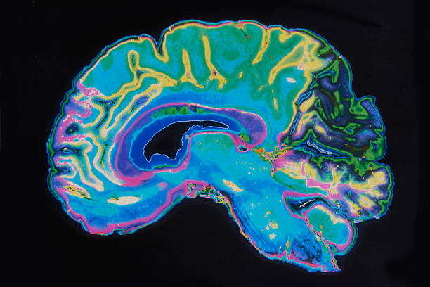 immagine rm cerebrale su sfondo nero - scansione scientifica foto e immagini stock