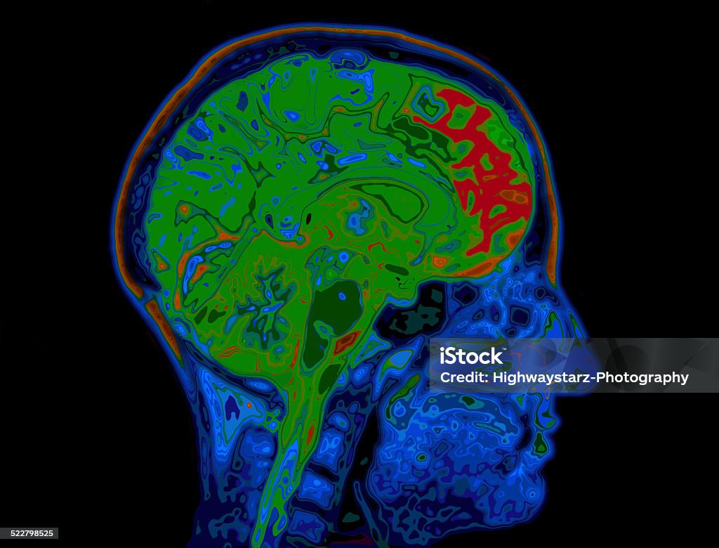 MRI Image Of Head Showing Brain MRI Scanner Stock Photo
