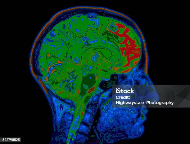 Mri Image Of Head Showing Brain Stock Photo - Download Image Now - MRI Scanner, Thermal Image, MRI Scan