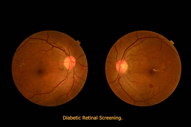istock Medical photo tractional (eye screen) diabetes retinal screening 522819075