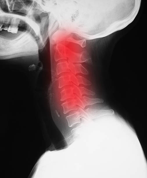 istock x-ray of neck, painful 522833351