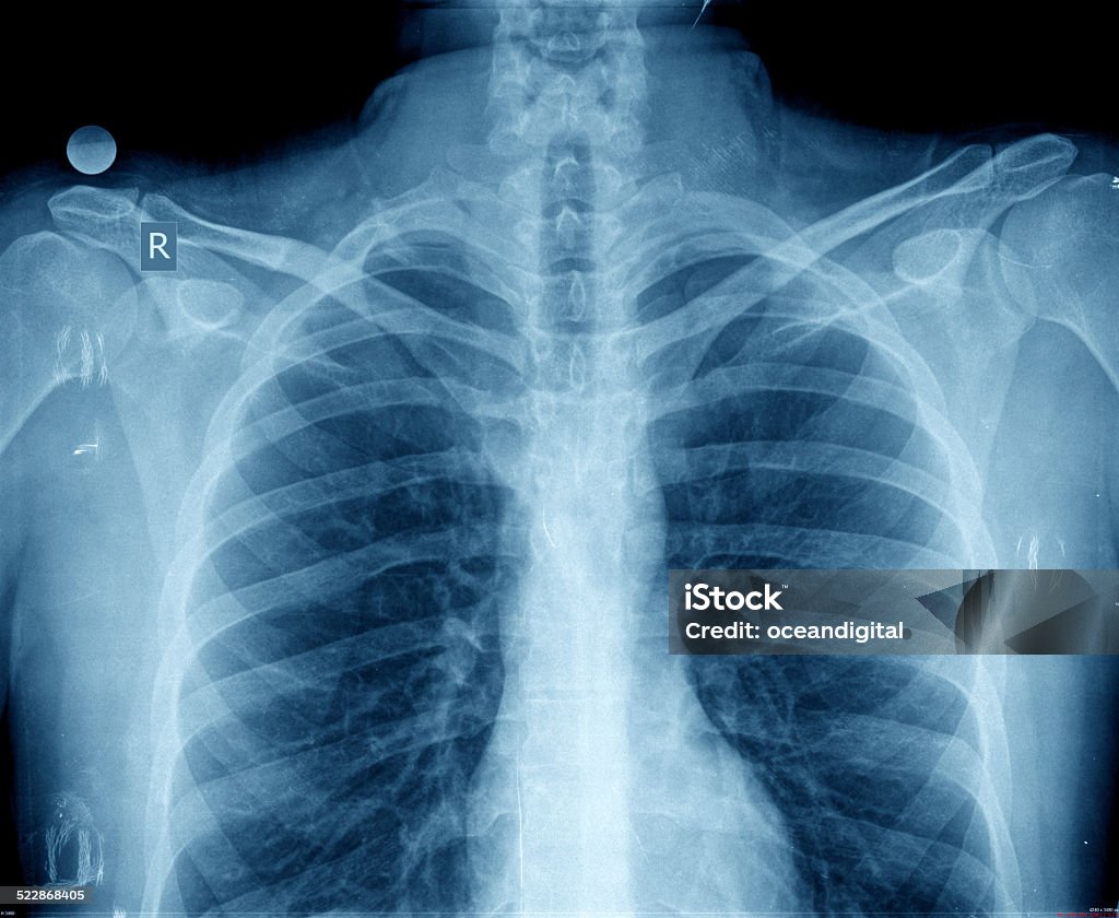 chest xray Abdomen Stock Photo