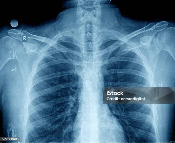 Chest Xray Stock Photo - Download Image Now - Abdomen, Anatomy, Antibiotic