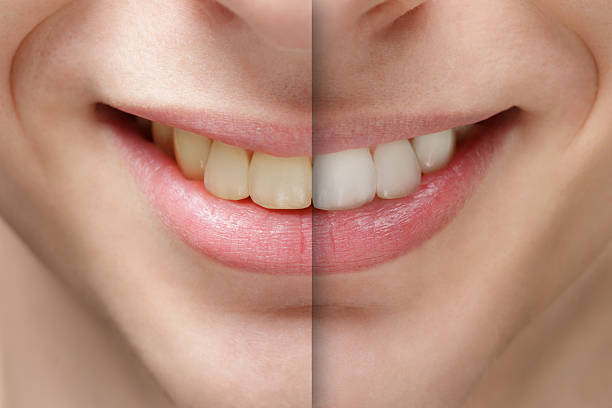 young man smile before and after teeth whitening - tipp ex stockfoto's en -beelden