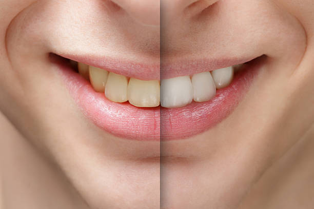 istock young man smile before and after teeth whitening 523001033