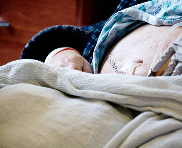 istock Kidney transplant scar with peritoneal dialysis tubing 523021071