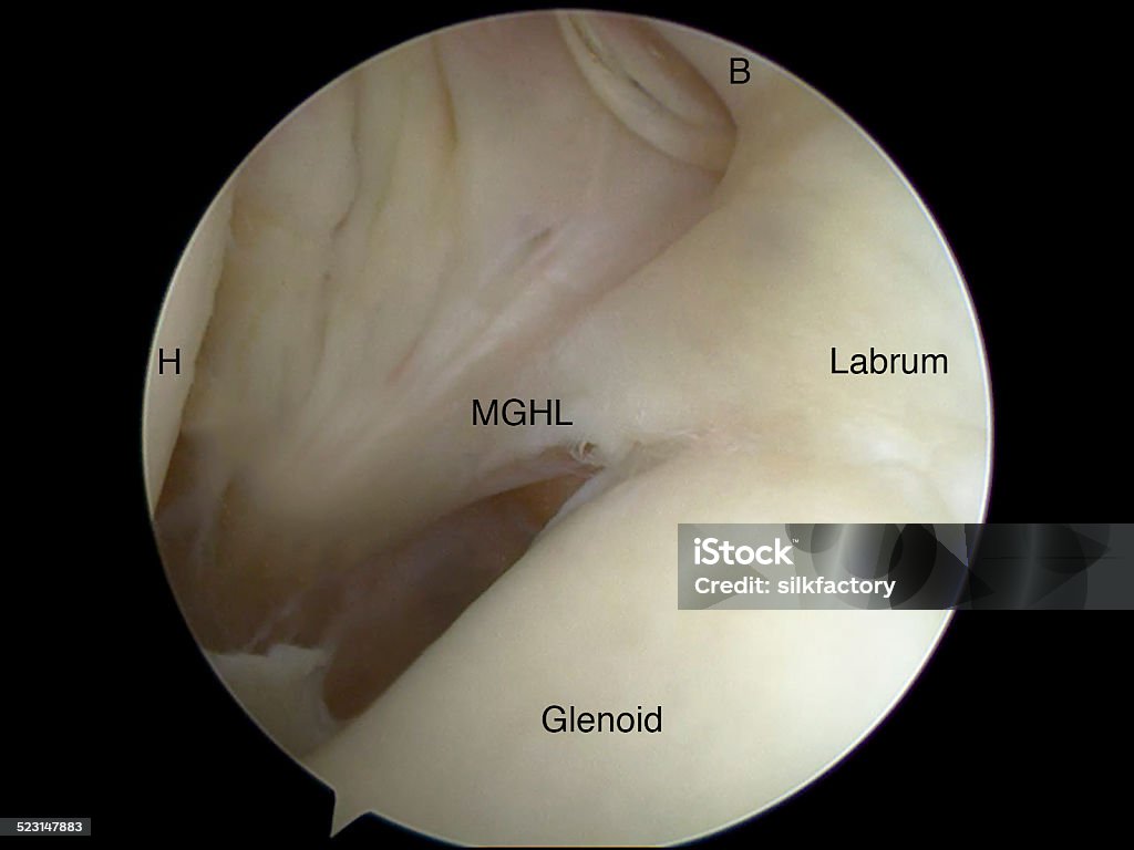 Arthroscopic view of Buford complex anatomic variant in shoulder Arthroscopic view (from posterior portal) of a left shoulder with an anatomic variant - called a Buford complex - consisting of a "cord-like" middle glenohumeral ligament (MGHL) that originates directly from the superior labrum at the base of the biceps tendon (B) and crosses the subscapularis tendon to insert on the humerus (H). Anatomy Stock Photo