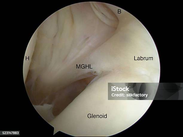 Arthroscopic View Of Buford Complex Anatomic Variant In Shoulder Stock Photo - Download Image Now