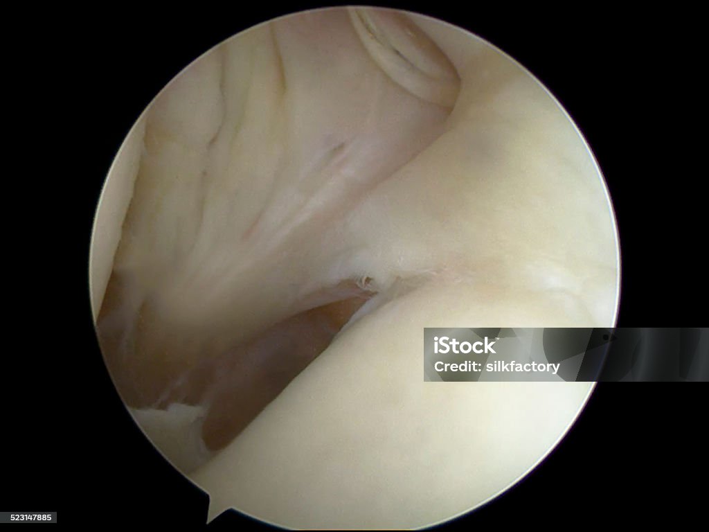 Arthroscopic view of Buford complex anatomic variant in shoulder Arthroscopic view (from posterior portal) of a left shoulder with an anatomic variant - called a Buford complex - consisting of a "cord-like" middle glenohumeral ligament (in the centre of the image) that originates directly from the superior labrum at the base of the biceps tendon and crosses the subscapularis tendon to insert on the humerus. Anatomy Stock Photo