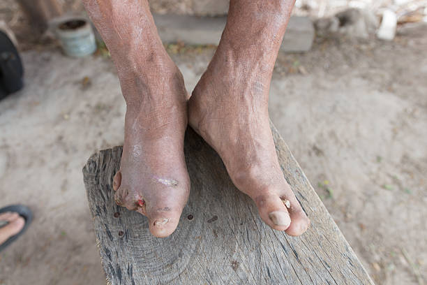 hansen la maladie, gros plan de mains du vieil homme souffrant de la lèpre - senseless photos et images de collection